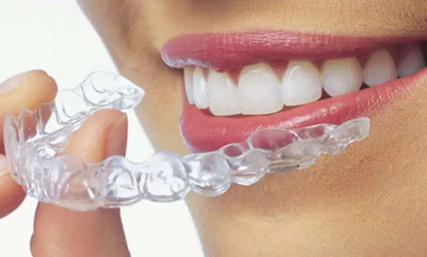 Clear Braces — Orthodontic Aligners