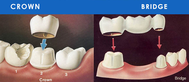 Crowns, Bridges, Veneers and Implants