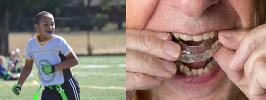 Mouthguards and Nightguards